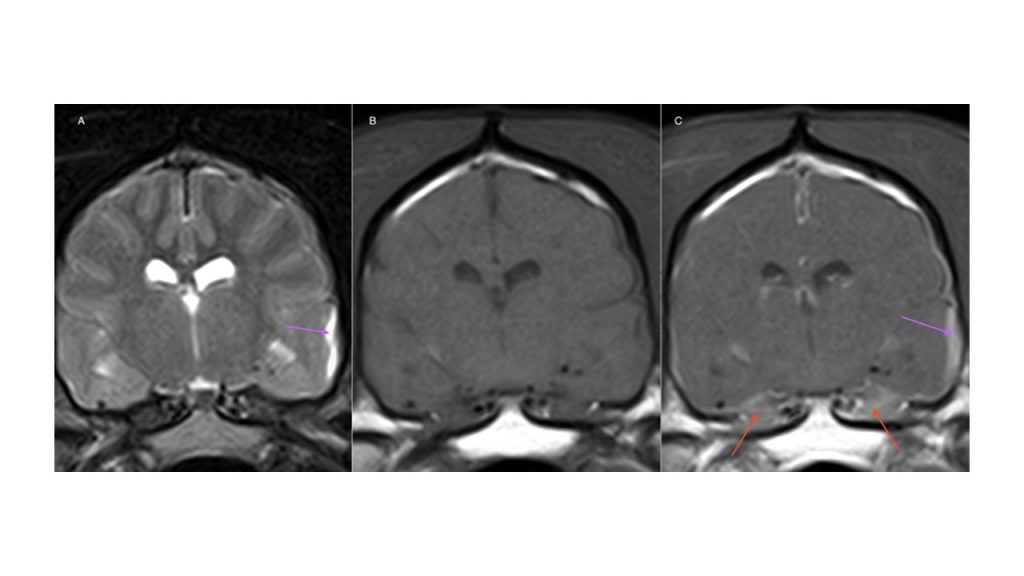 Hypertrophic Meningitis