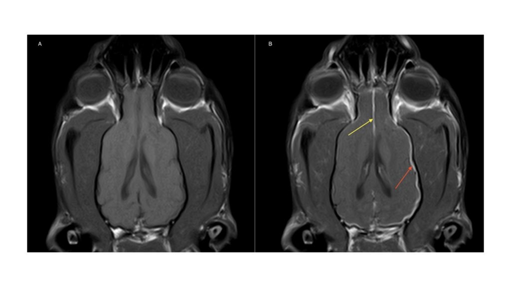 Hypertrophic Meningitis