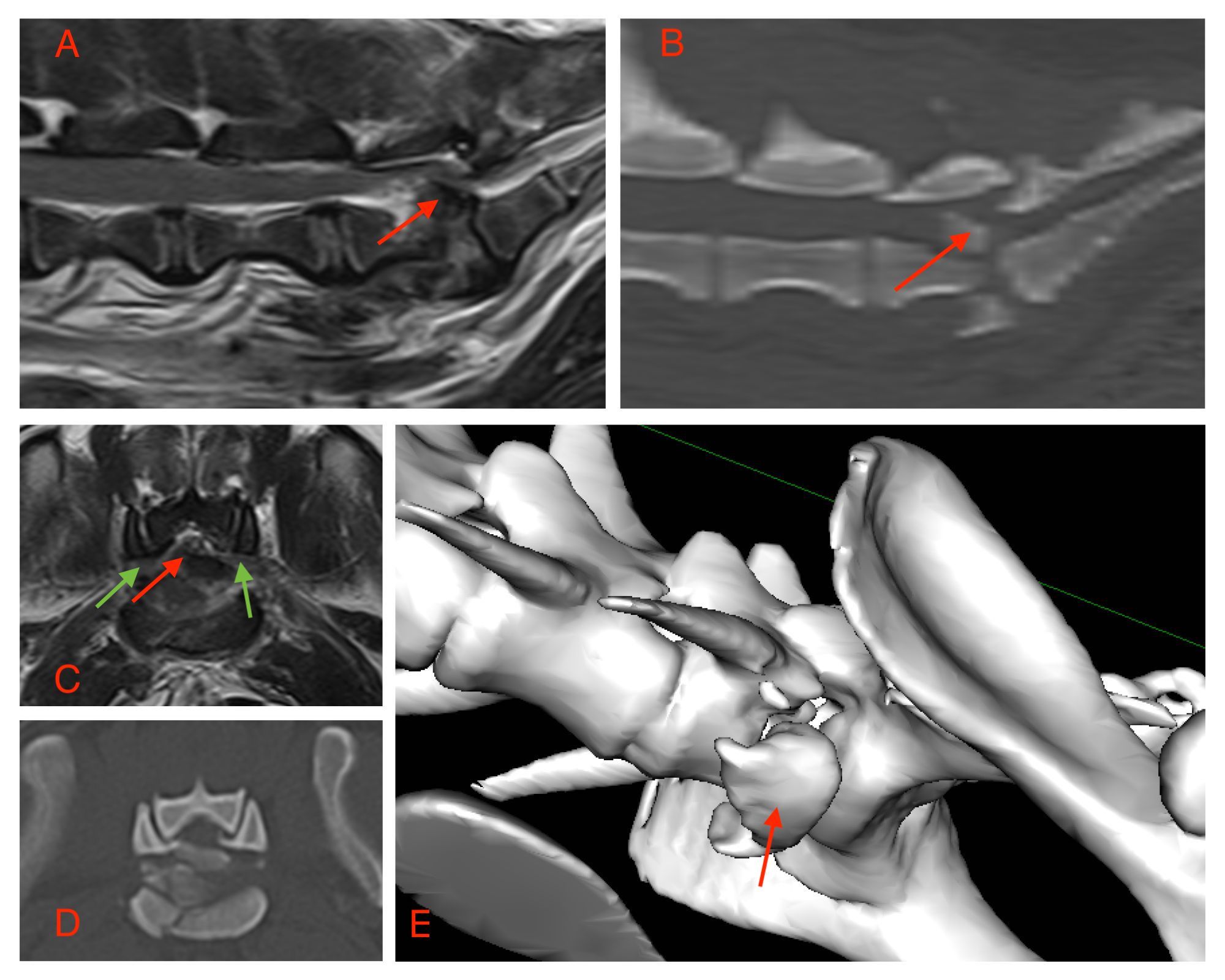 Computed tomography scan of the dorso-lumbar spine showing no