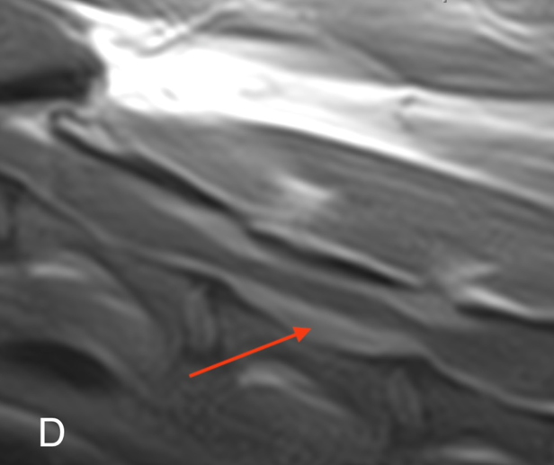 D. Sagittal T1W post-contrast of the same region, as seen in C. Note the strong enhancement of the meninges and the peripheral enhancement of the epidural lesion (arrow).