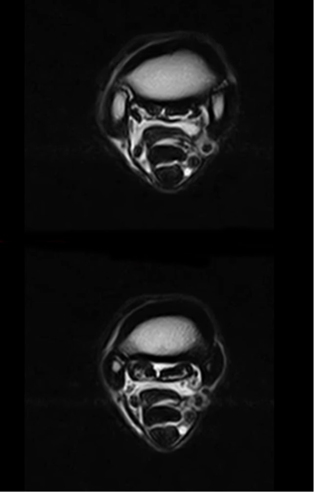 T2 FSE TRA iNAV proximal suspensory<br>
