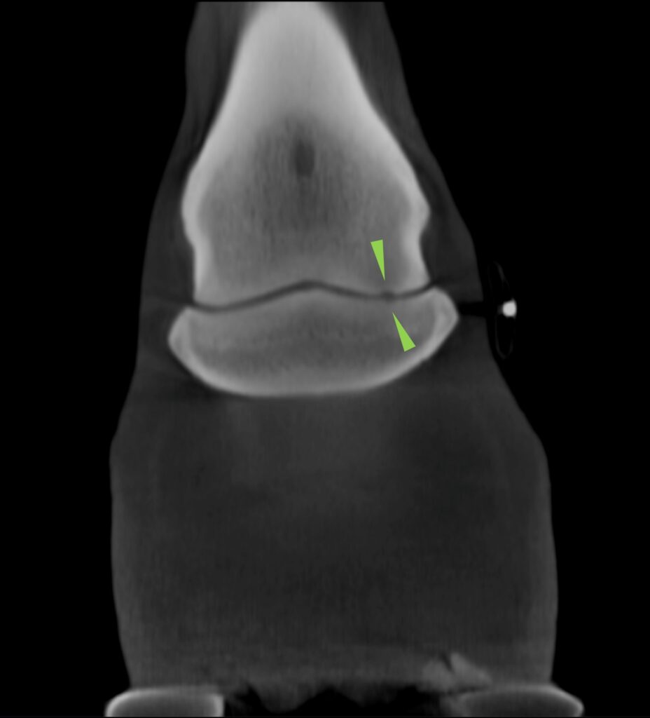 Vision CT image showing a small and poorly marginated region of hypoattenuation of the adjacent trabecular bone (green arrows)