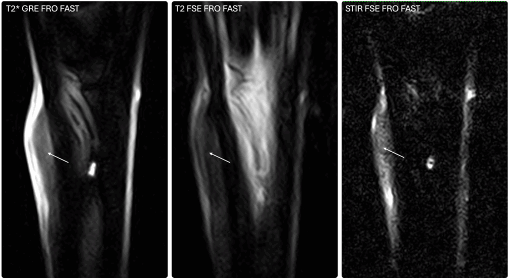 Frontal images of the metacarpal region showing equine exostosis of the second metacarpal bone.