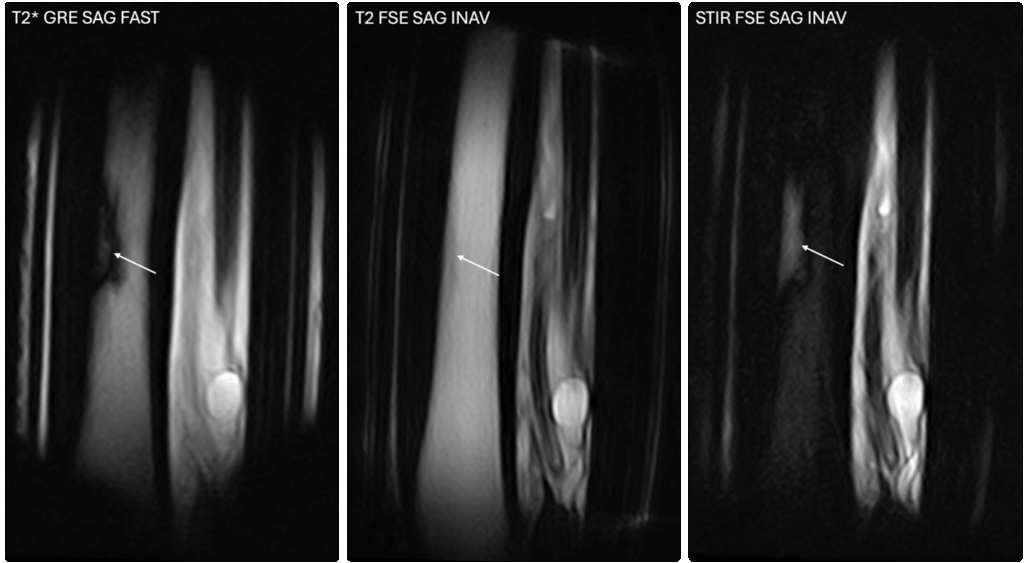 Sagittal images of the third metatarsal bone showing marked inflammation or infection.