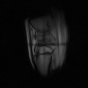 When scanning the proximal limb, signal distribution can be improved by making small adjustments to the coil height.