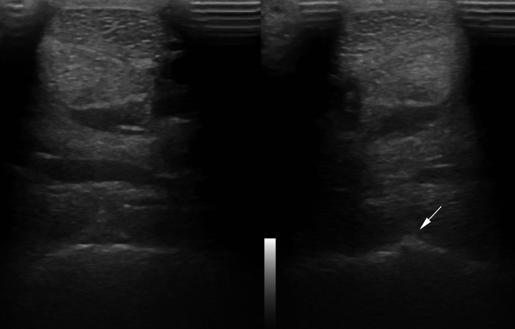 Fig.1- Left and right front PSL and flexor tendons in transverse ultrasonographic scanning. A focal bone protrusion is present at the back side of the cannon bone at the origin of the PSL