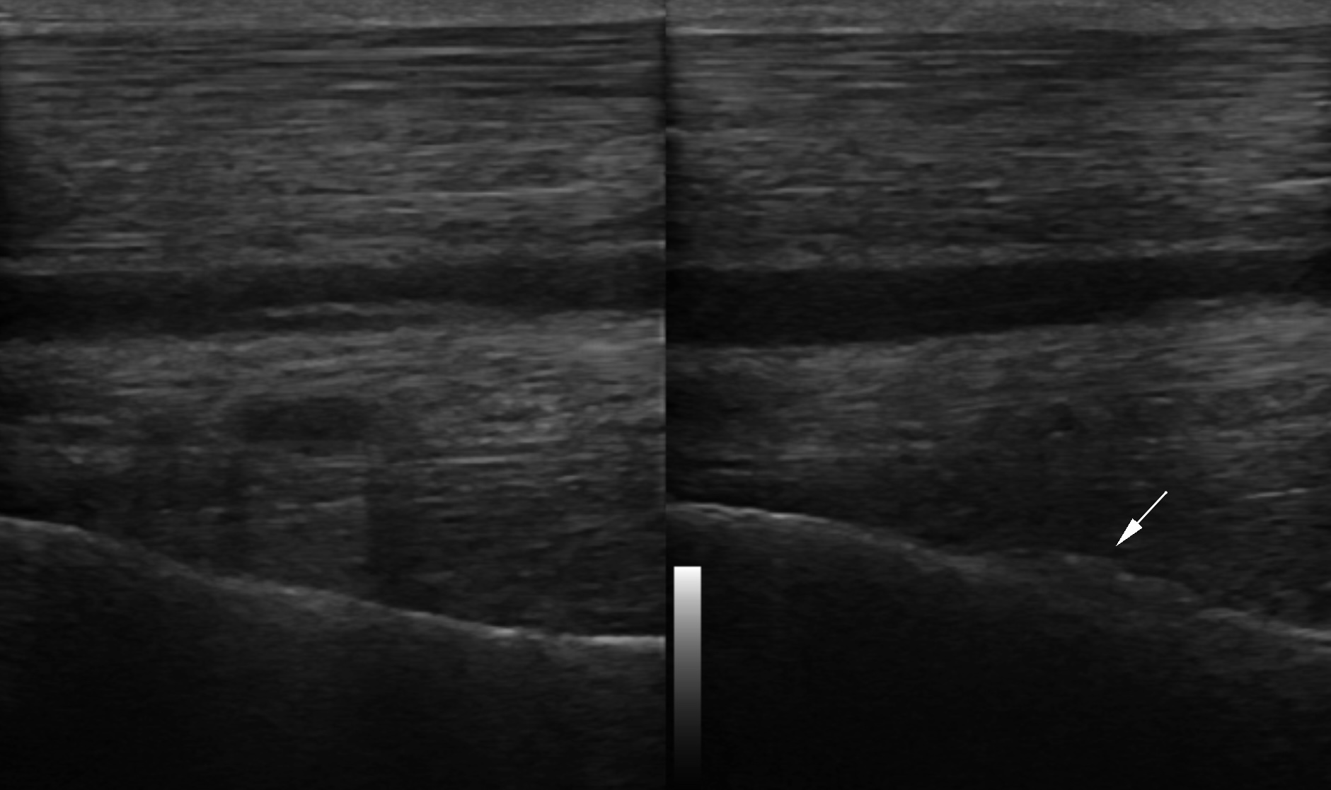 Fig.2 - Left and right front PSL and flexor tendons in longitudinal ultrasonographic scanning. A ridge of bone is present at the back side of the cannon bone at the origin of the PSL.