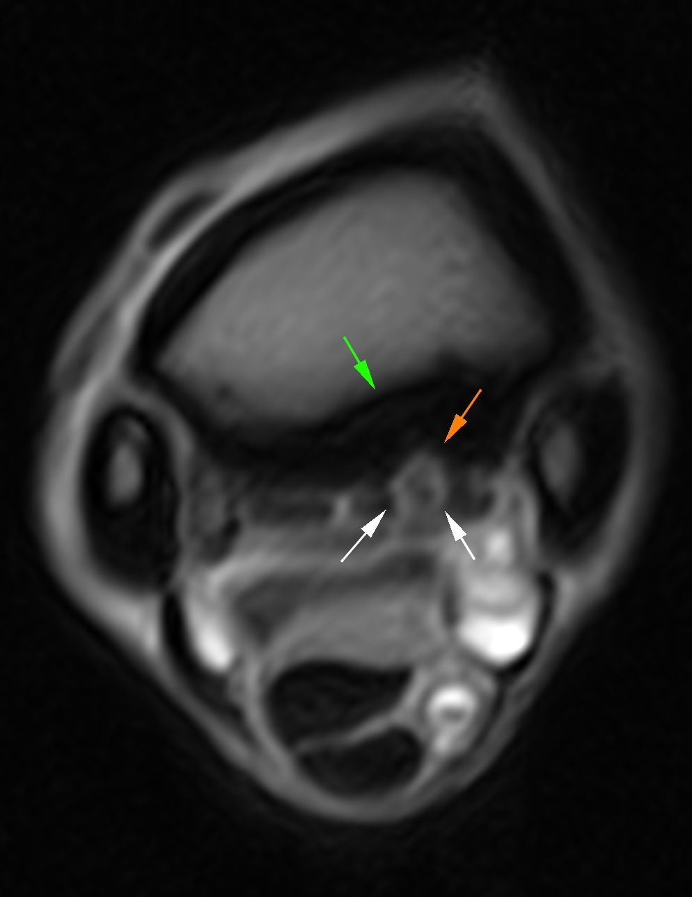 Fig. 3 - T2*W transverse MRI image of the proximal aspect of the cannon bone at the origin of the PSL. A large lesion is present in the medial lobe of the PSL (white arrows) with a defect in the back side of the cannon bone (orange arrow) and surrounding sclerosis (green arrow).
