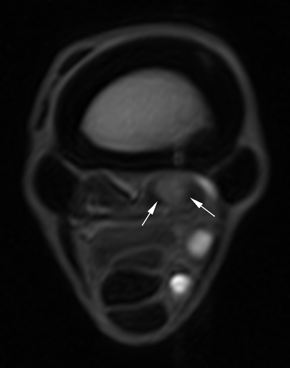 Fig. 4 - T1W transverse MRI image of the proximal aspect of the cannon at the proximal body of the PSL.
A large lesion is present in the medial lobe of the PSL.