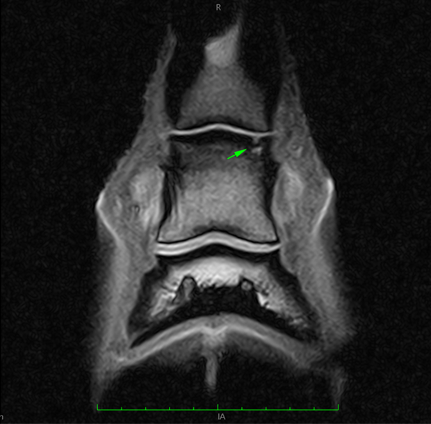 T1W frontal MRI image (lateral to the left) showing the osseous cyst-like lesion in the medial glenoid of the middle phalanx.