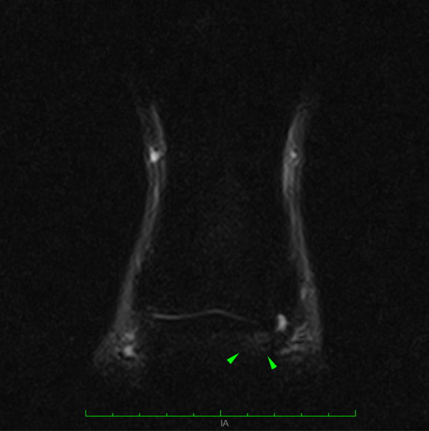 STIR frontal MRI image