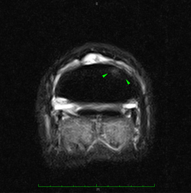 STIR transverse MRI image (lateral to the left)