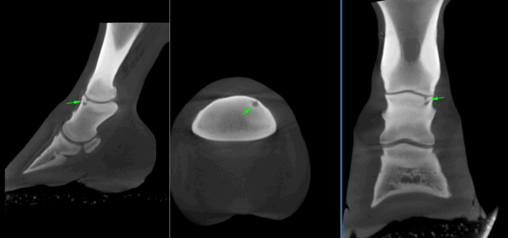 3D reconstructed CT image showing the osseous cyst-like lesion in the medial glenoid of the middle phalanx, with a small communication to the articular surface.