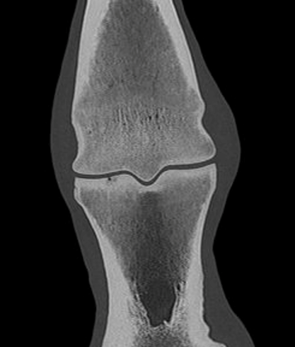 CT image of the fetlock clearly demonstrating a subtle subchondral lucency at the articular surface. (Images courtesy of Elisabetta Giorio).
