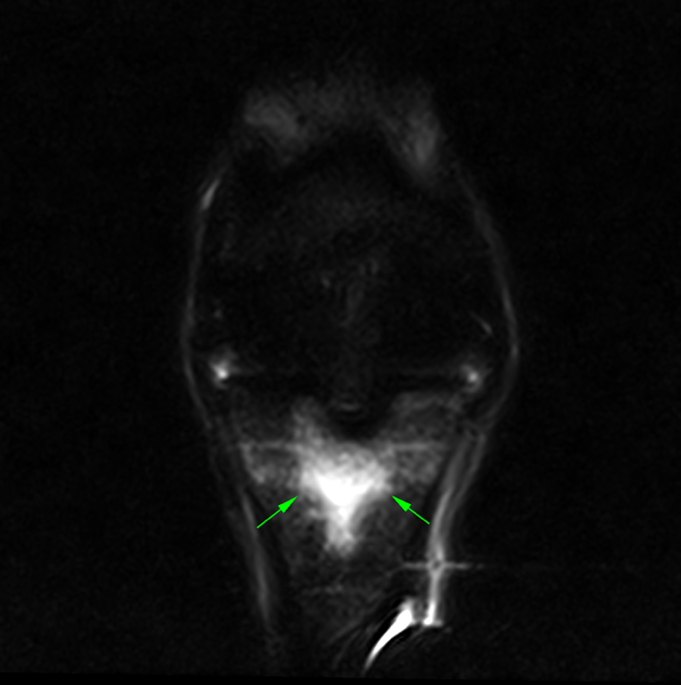 STIR frontal MRI image of the equine fetlock showing bone oedema-like signal at the sagittal groove.