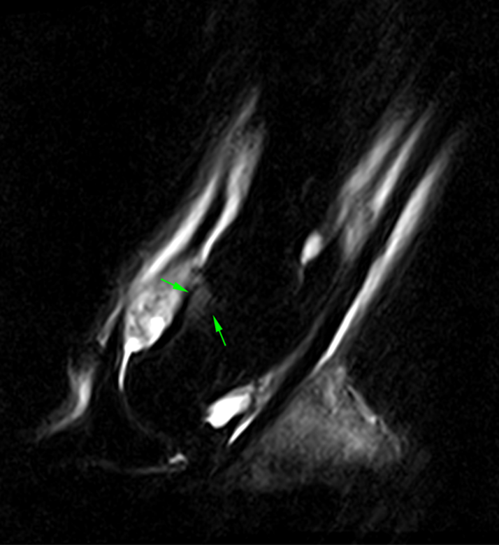 STIR sagittal frontal MRI image showing the area of bone oedema-like signal of the middle phalanx.