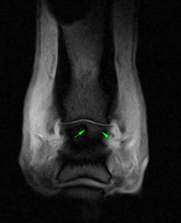 T2*W frontal MRI image showing the area of bone oedema-like signal of the middle phalanx.