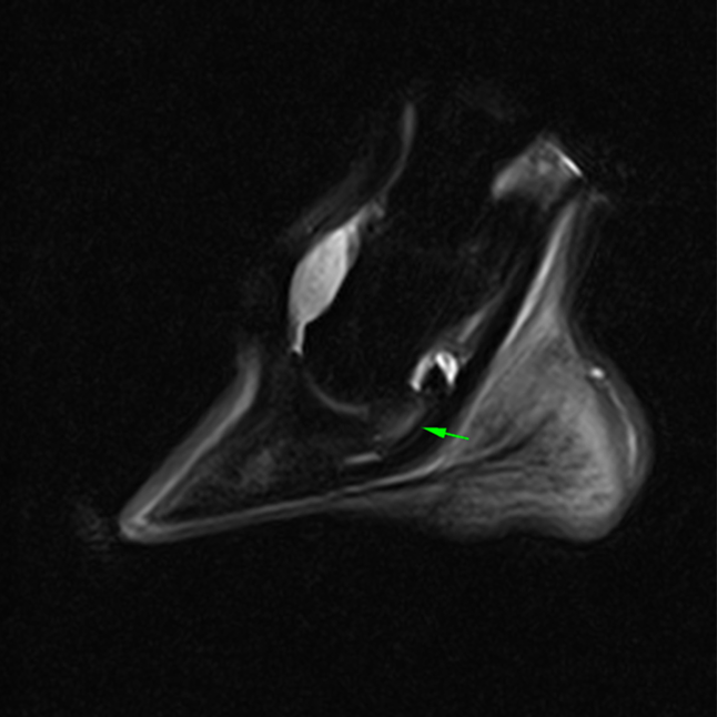STIR sagittal MRI image showing bone oedema-like signal of the navicular bone.