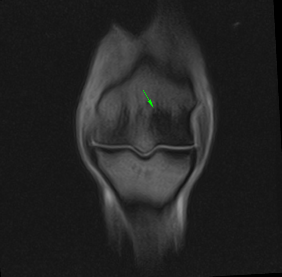 T1W frontal MRI image of a fetlock showing sclerosis of the condyle.