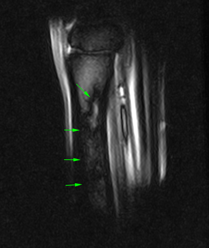 T2*W and STIR sagittal MRI images of the proximal metacarpal region (dorsal is on the left) showing the marked presence of fluid signal in the proximal metacarpal region and the metacarpal medulla.