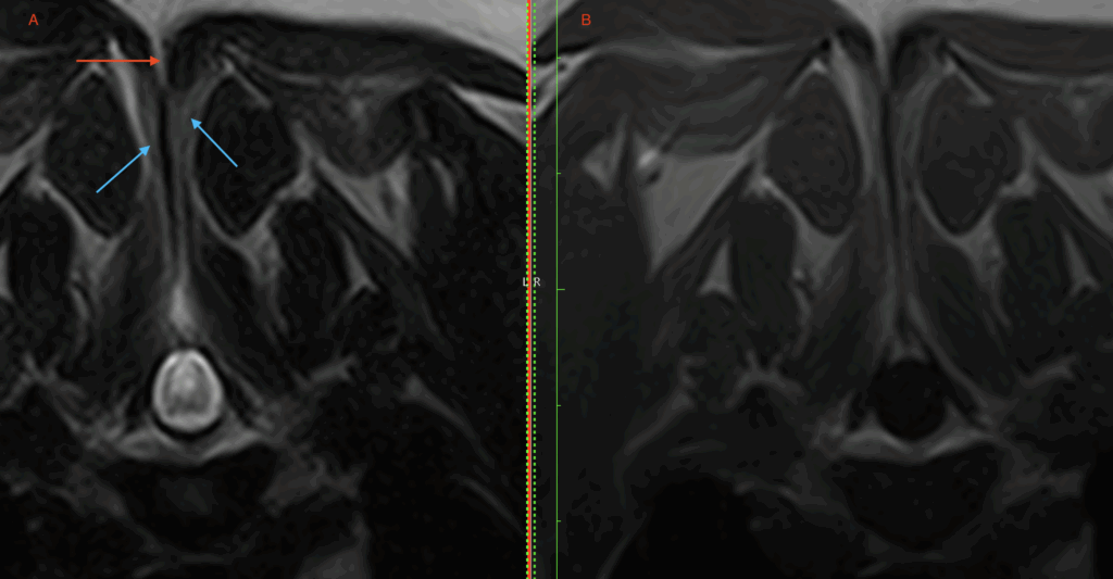 A dermoid cyst, meningomyelocele, and spina bifida in an adult dog