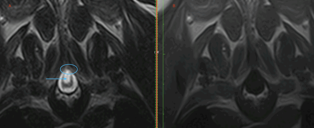 A dermoid cyst, meningomyelocele, and spina bifida in an adult dog