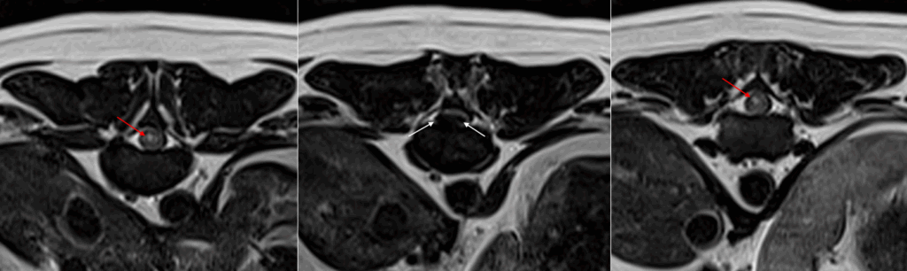 MRI for the perioperative management of thoracolumbar intervertebral disc extrusion (IVDE)