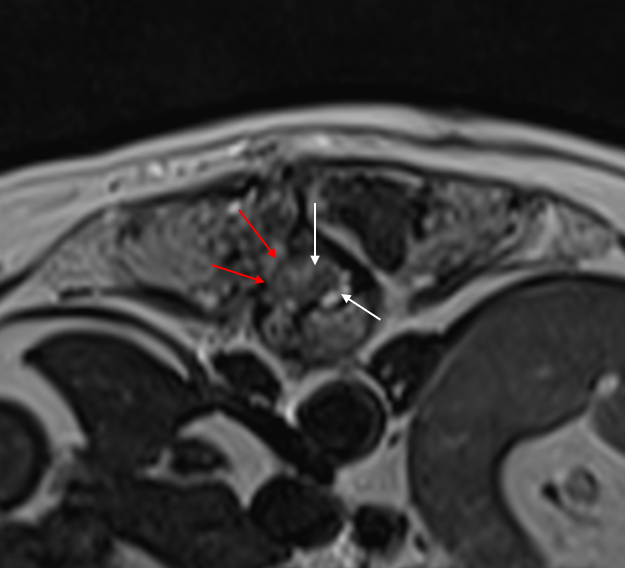 MRI for the perioperative management of thoracolumbar intervertebral disc extrusion (IVDE)