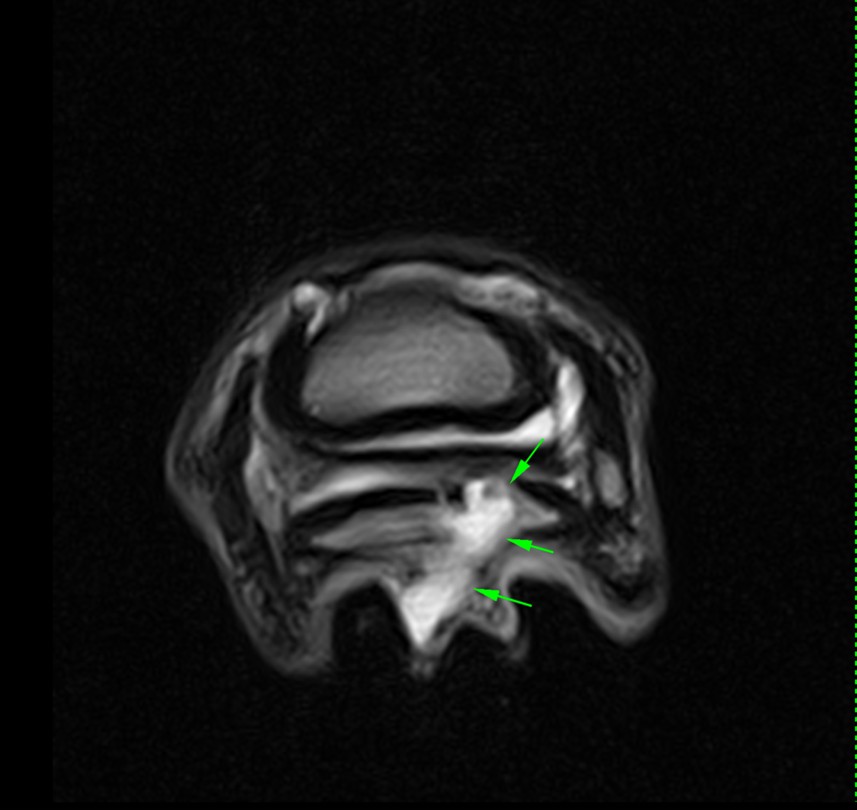 MRI image showing chronic solar penetration.