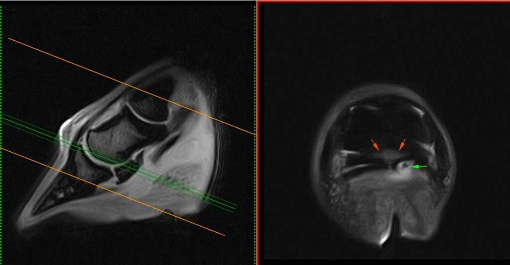 MRI image showing chronic solar penetration.