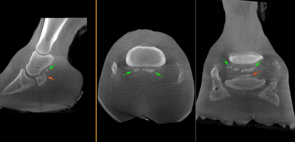 Extensive mineralization of the collateral sesamoidean ligament