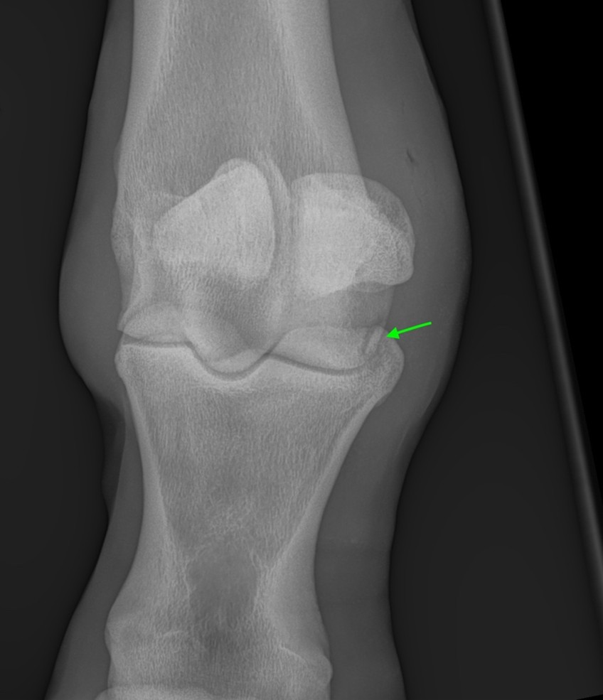 DMPLO radiograph of the left hind fetlock showing the fragment from the medial articular margin of the third metatarsal bone.