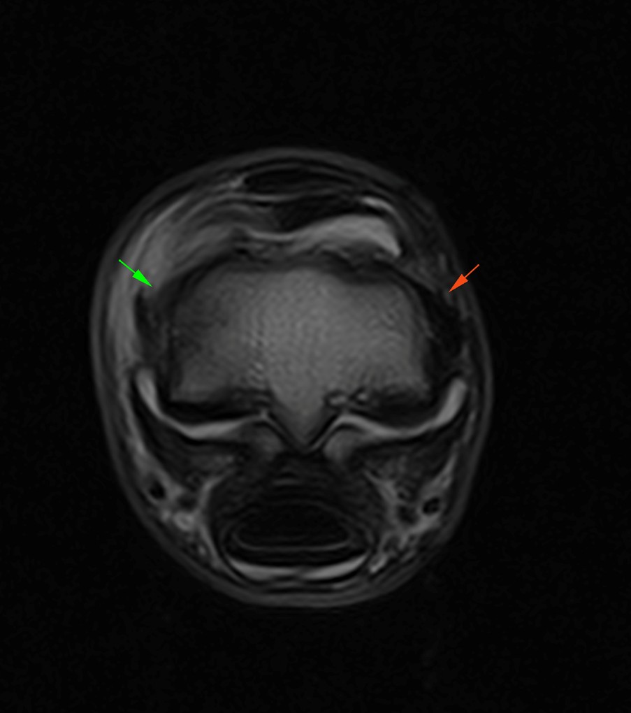 Long medial collateral ligament injury of the fetlock joint