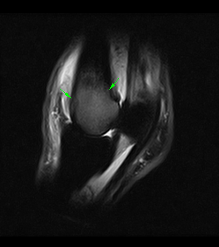 Sagittal STIR FSE iNAV MR image
