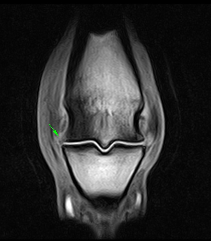 Frontal T1W 3D iNAV MR image