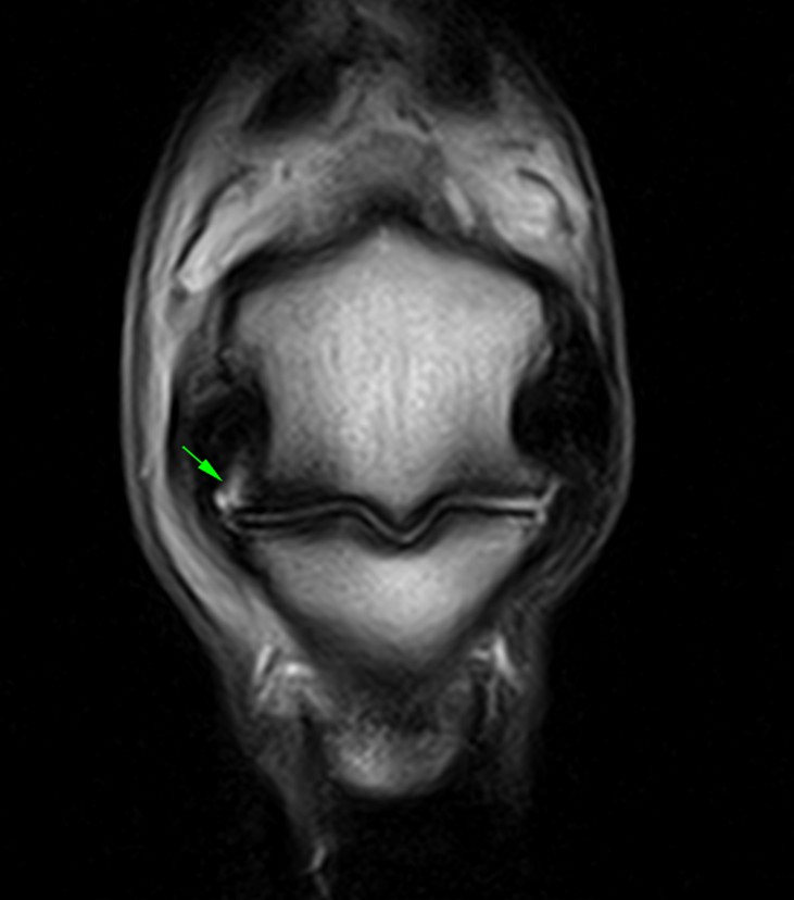 T2 FSE iNAV MR image