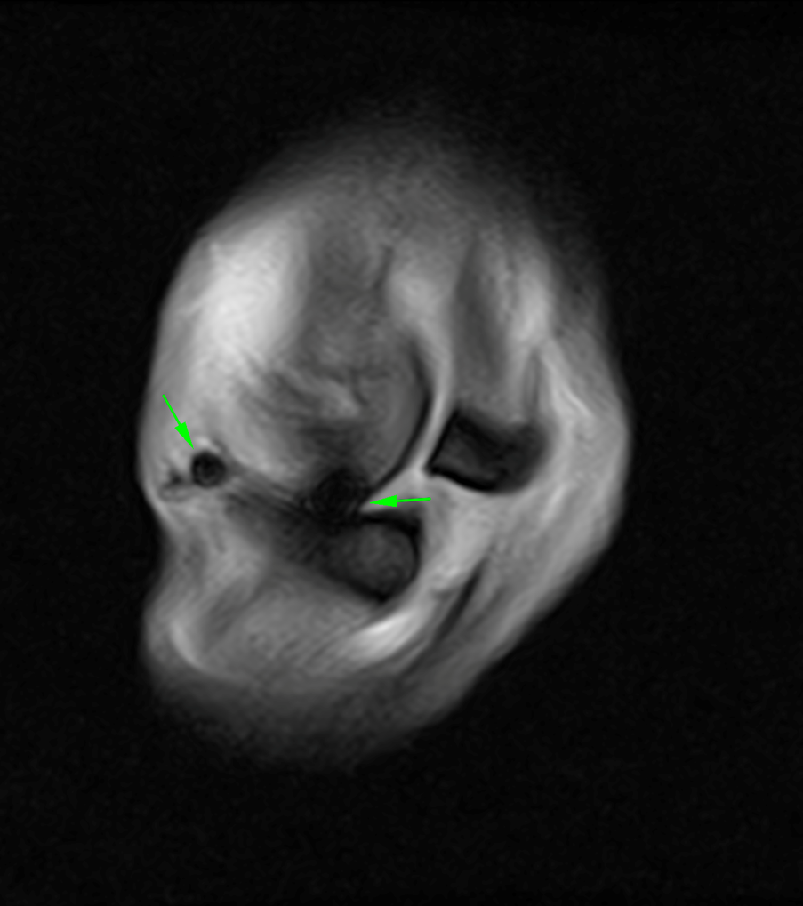 Figure 5: Sagittal T2*W GRE FAST sequence showing magnetic susceptibility artifacts present within the medial aspect of the fetlock joint