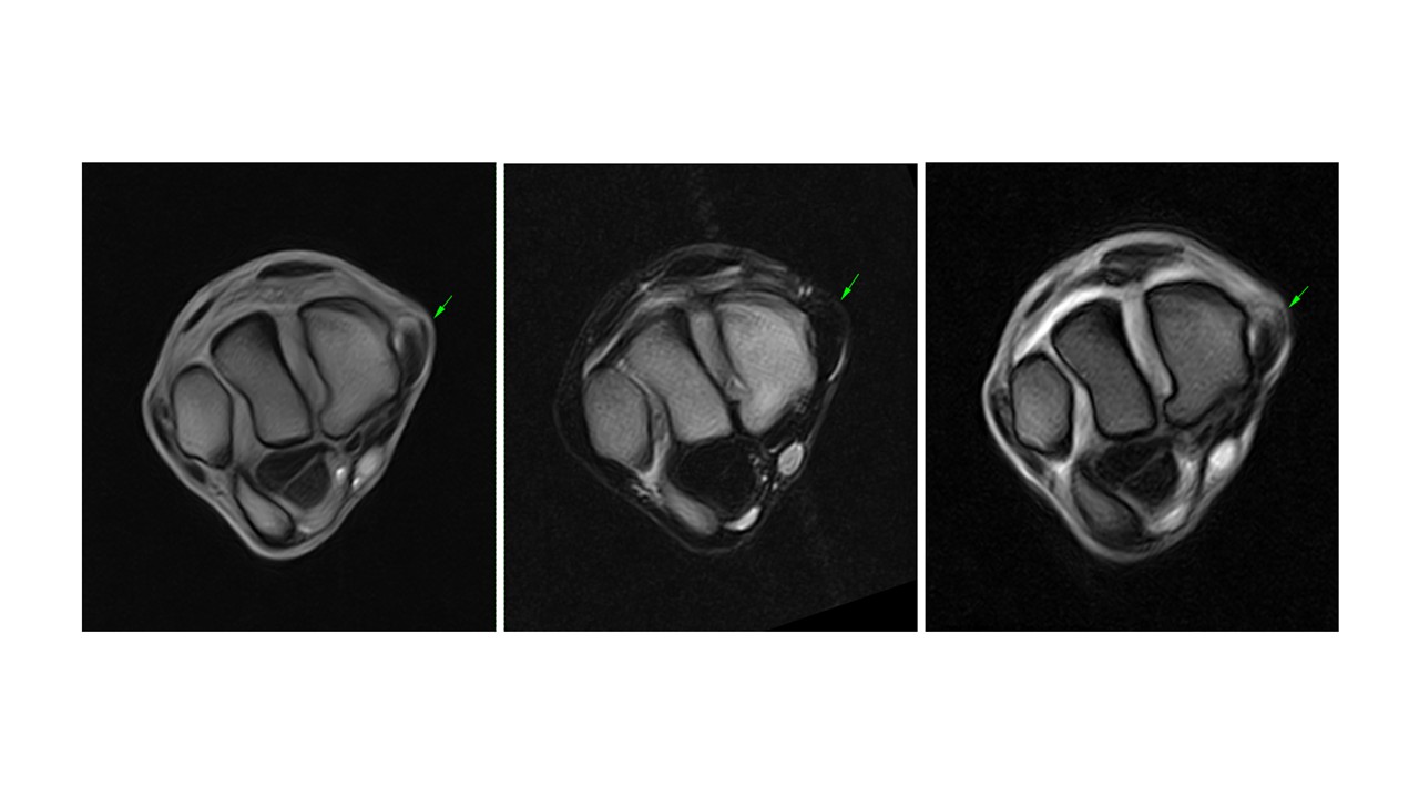 MRI scan showing: Transverse T1W GRE MI, T2W GRE iNAV and T2W* GRE MI showing the changes in the medial collateral ligament of the carpus.