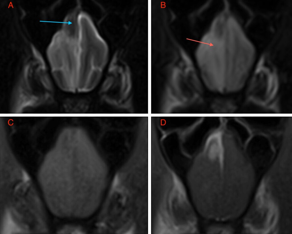 Coccidioidomycosis - Figure 1. (A) Transverse T2W, (B) Transverse FLAIR, (C) Transverse T1W pre-contrast and (D) Transverse T1W post-contrast images of the brain at the level of the frontal lobe. Red arrow – perilesional edema; Blue arrow – mass lesion