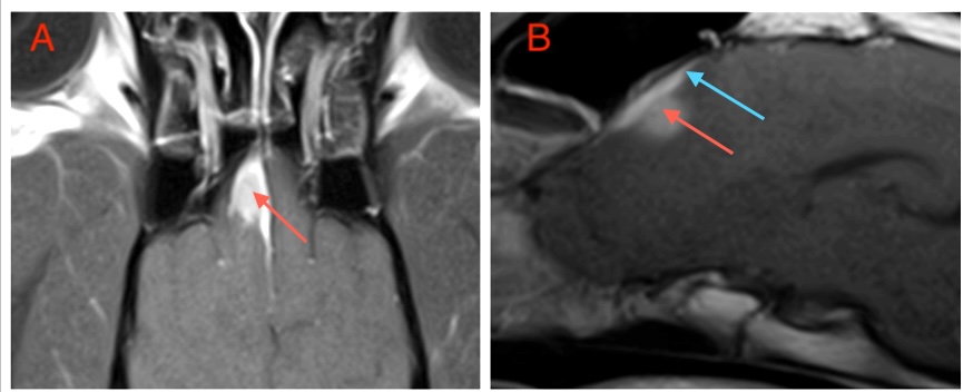 Coccidioidomycosis - Figure 2. (A) Dorsal T1W images of the brain post-contrast, (B) Sagittal T1W images of the brain post-contrast. Blue arrow – dural tail; Red arrow – mass lesion.