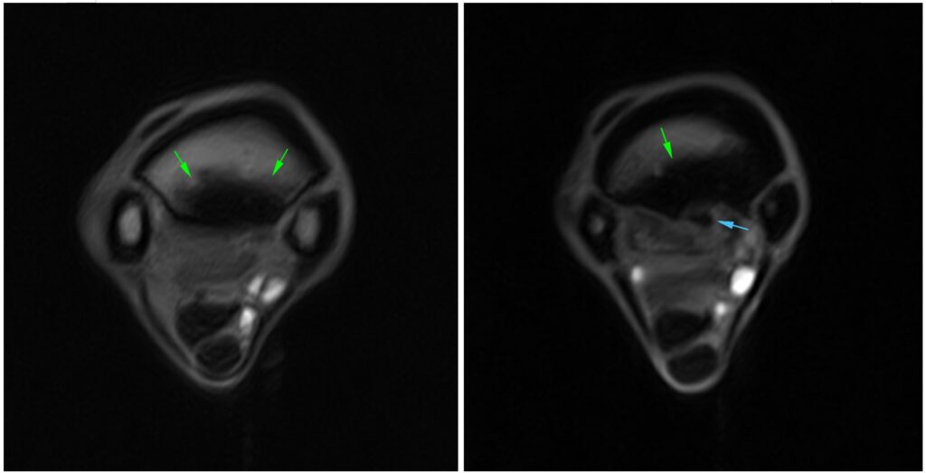 T1 GRE MI transverse scans showing the sclerosis of the proximal metacarpus (green arrows) and the avulsion fragment (blue arrow).