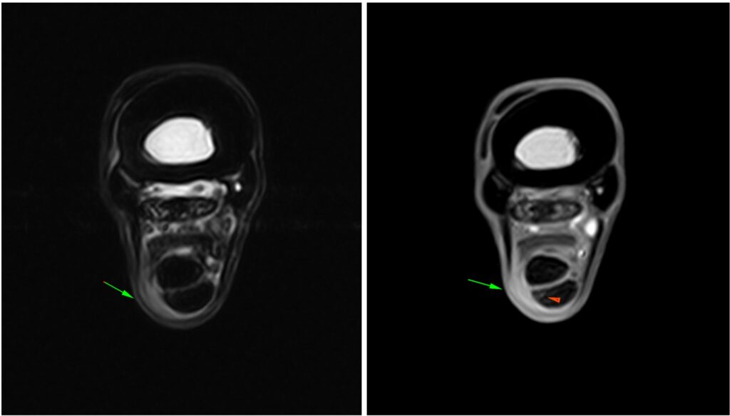 Figure 1: Transverse T2W FSE iNAV PAICE and T1W GRE FAST showing the thickened soft tissue material on the lateral margin of the flexor tendons (green arrows) and the mildly irregular and heterogeneously hyperintense lateral margin of the SDFT (red arrowhead).