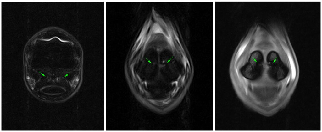 Figure 1: Transverse and frontal STIR FSE iNAV and T2*W GRE iNAV sequences showing changes within the proximal sesamoid bones.