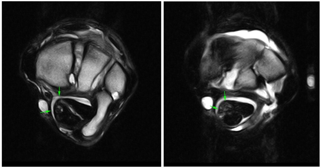 Figure 1: Transverse T2W FSE iNAV PAICE showing the irregular medial margin of the SDFT, loss of conspicuity of the medial blood vessels and loss of separation with the DDFT.
