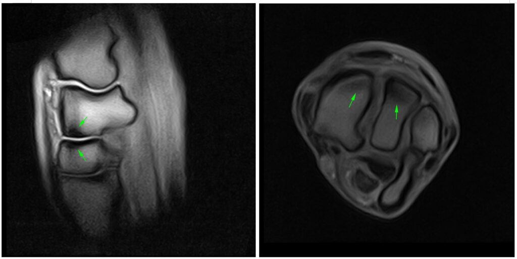 Figure 2: Sagittal and transverse T1W GRE FAST showing the adaptive modelling of the carpus.