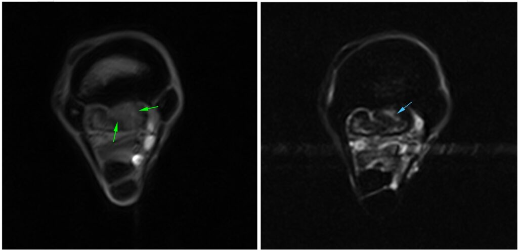 T1 GRE MI and STIR FSE INAV transverse scans showing the enlargement and signal alterations of the medial lobe of the suspensory ligament indicating chronic fibrosis (green arrows), and the fluid signal consistent of ongoing inflammation (blue arrow).