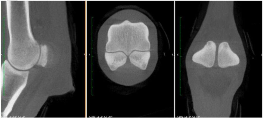Figure 4: 3D reconstructed CT image of the right fetlock showing normal appearance of the proximal sesamoid bones.