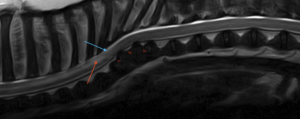 A T2W sagittal image of the thoracolumbar vertebral column. There is an abrupt truncation and mild expansion of the dorsal subarachnoid space over the T6-T7 disc space (blue arrow) and an ill-defined and irregular intramedullary T2W hyperintensity over several vertebrae immediately cranial to this site (red arrow).