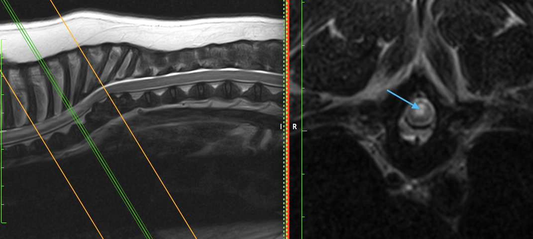 (B) A T2W transverse image of the vertebral column at the level of T6. There is an ill-defined and irregular ovoid intramedullary lesion centered on the dorsal midline of the cord, which is markedly T2W hyperintense (arrow).