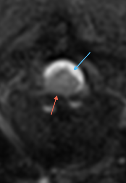 A T2W transverse image of the vertebral column at the level of T6-T7. There is a relatively well-defined intradural expansion dorsal to the cord, more prominent on the left, with mild underlying cord compression (blue arrow).
There is an ill-defined and irregular ventral extradural lesion over the disc space, which is T2W hypointense and associated with obliteration of the ventral subarachnoid space (red arrow).